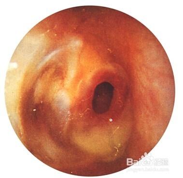 兒童慢性化膿性中耳炎的幾種鼓膜穿孔圖。