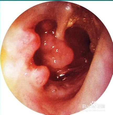兒童慢性化膿性中耳炎的幾種鼓膜穿孔圖。