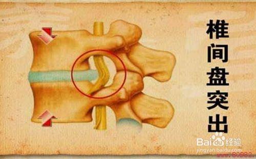 如何預防腰椎間盤突出