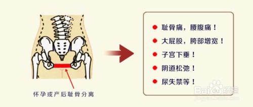 恥骨疼怎麼辦產後恥骨疼怎麼辦