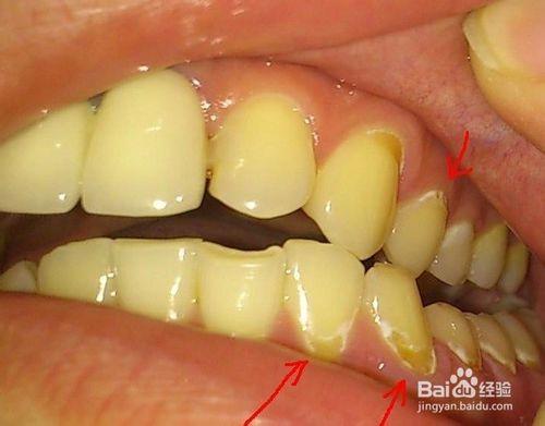 總是牙齦出血怎麼辦?