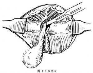 尾椎骨處爛了個洞怎麼辦