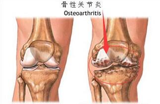 關節炎、風溼病：自我治療、小常識。