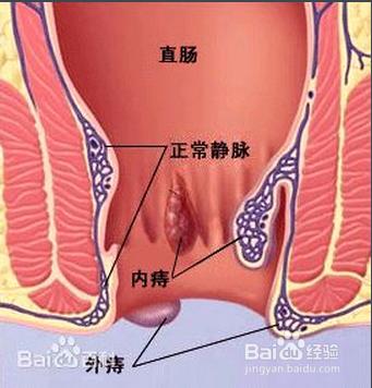 孕婦痔瘡怎麼辦？怎麼預防和治療？