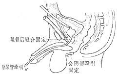 前列腺癌術後併發症怎麼護理？