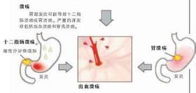 引發胃潰瘍的幾大殺手