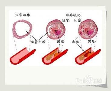 如何清除降壓西藥的副作用