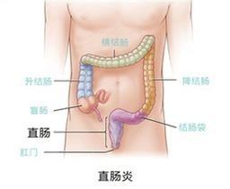 如何有效治療慢性結腸炎