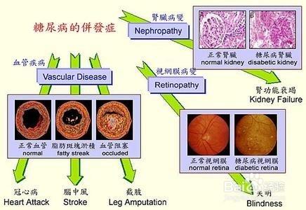 糖尿病人降糖藥物的調整與聯用