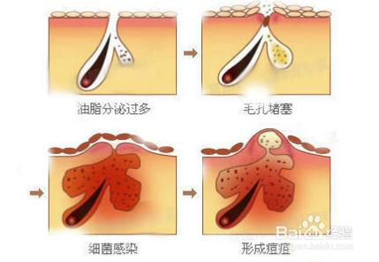 出油 長痘痘 青春痘 痤瘡