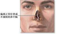 鼻中隔偏曲的症狀及治療