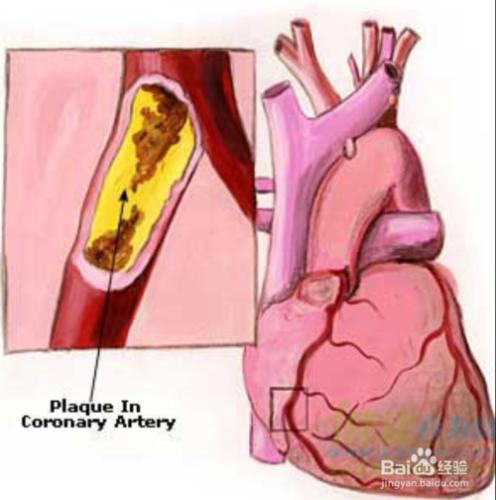 臨床心絞痛與心肌梗塞的區別與防治