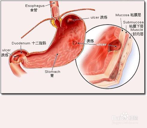 疾病信號——如何判斷腹痛是什麼病