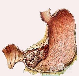 疾病信號——如何判斷腹痛是什麼病