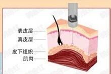 打瘦臉針注意的事項