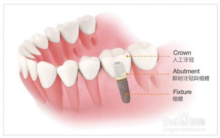 門牙整體斷了怎麼辦