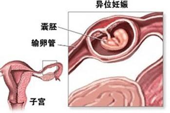 發生宮外孕之後，我們應該怎麼做