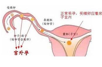 發生宮外孕之後，我們應該怎麼做