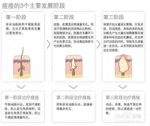 戰勝青春痘的方法