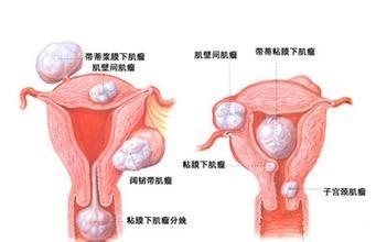 得了子宮肌瘤是否需要手術以及注意事項