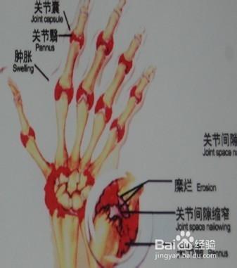 如何有效解決手指攀巖受傷的辦法