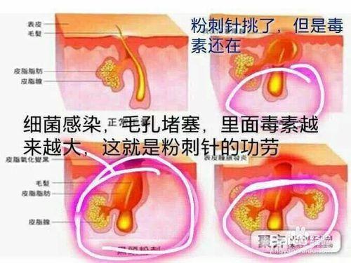 痘痘原因 類型清理及保護