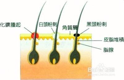 封閉性痘痘的治療方法