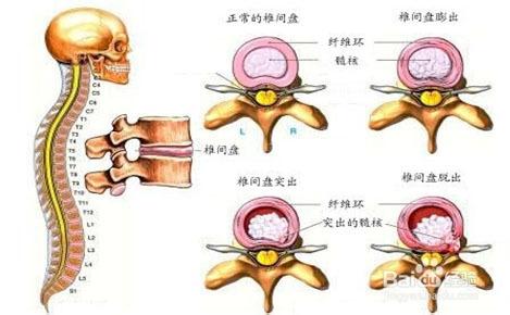 頸、腰椎間盤突出的誘因及預防措施