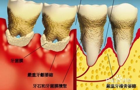 你瞭解多少牙周炎的症狀