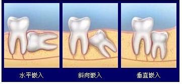 為什麼很多人會長出智齒