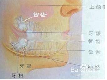 如何避免智齒髮炎以及發炎的護理