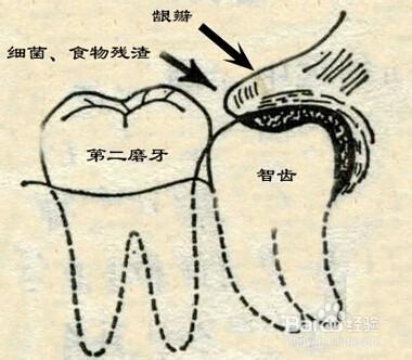 成人智齒冠周炎怎麼治療?