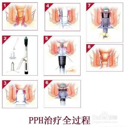 痔瘡治療方法\痔瘡的症狀\痔瘡偏方