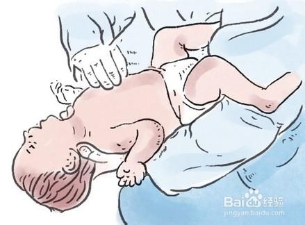 嬰兒氣道異物梗阻的急救方法