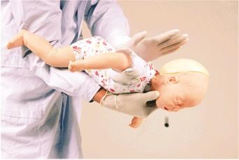 嬰兒氣道異物梗阻的急救方法