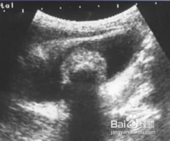 前列腺，膀胱，輸尿管常見病變影像B超圖片。