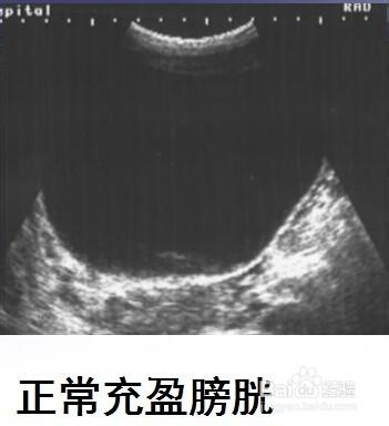 前列腺，膀胱，輸尿管常見病變影像B超圖片。