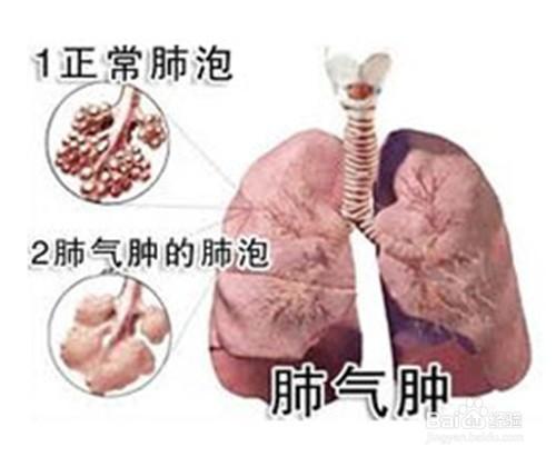 得了肺氣腫會傳染給別人嗎