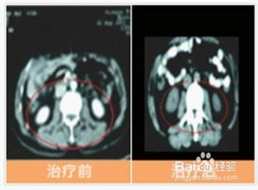 膀胱癌的病因和治療