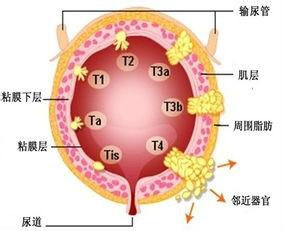 膀胱癌的病因和治療