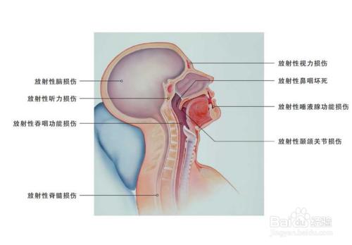 怎樣減輕放療的毒副作用