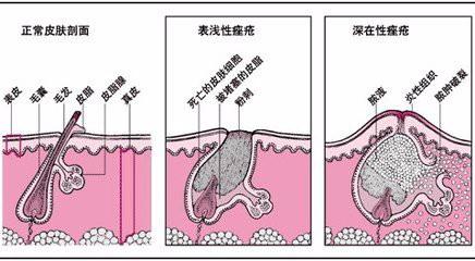 什麼原因引起的青春痘？