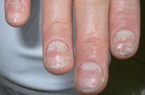 指甲變厚是怎麼回事?有些有點變黃是灰指甲嗎？