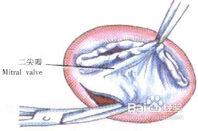 二尖瓣置換術手術步驟有哪些