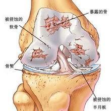 風溼病的病因