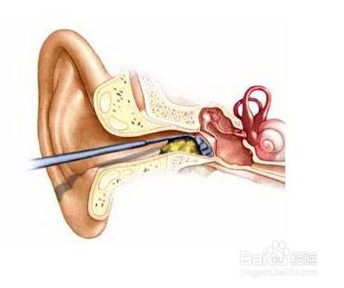 怎麼清理耳朵裡的耵聹？