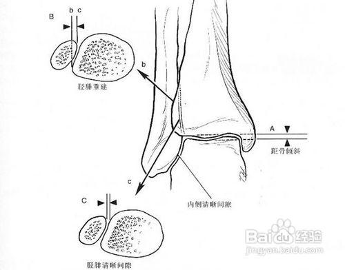 膝關節骨質增生怎麼辦