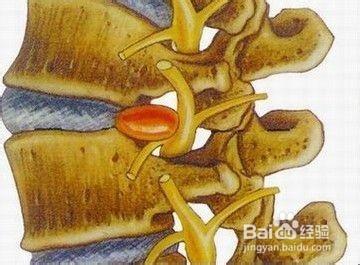 預防骨質增生和簡易治療方法