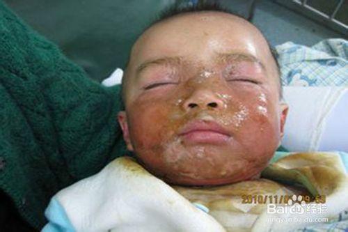 小孩輕中度面部燙傷的治療和護理體會