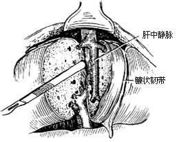 右半肝切除術手術步驟詳解